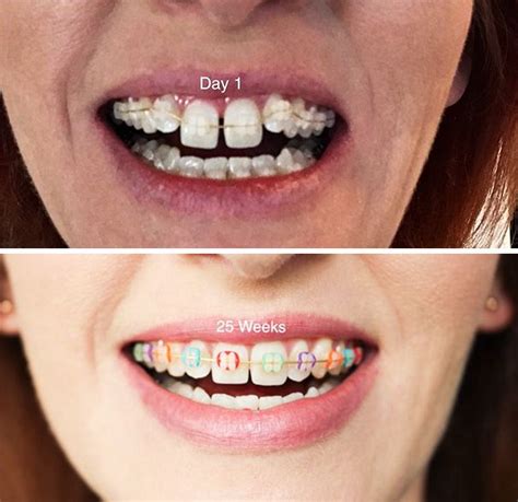 Discover the World of Magic Teeth Braces: Embrace a Lifetime of Beautiful Smiles